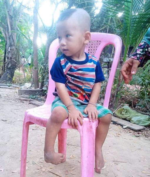young-boy-with-one-clubfoot-sitting-on-a-chair